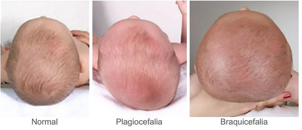 Plagiocefalia: ¿Cómo prevenir y tratar la cada vez más frecuente deformidad  de cabeza de los bebés?