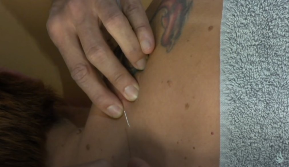 Agujas fisioterapia